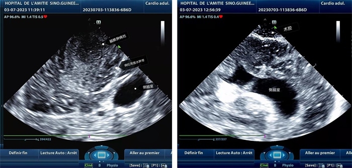 左圖顯示術(shù)中超聲見囊實(shí)性病變，大小約為4x4x3cm，病灶周圍腦組織水腫明顯；右圖為病灶切除后，術(shù)中超聲示術(shù)腔無病變殘留