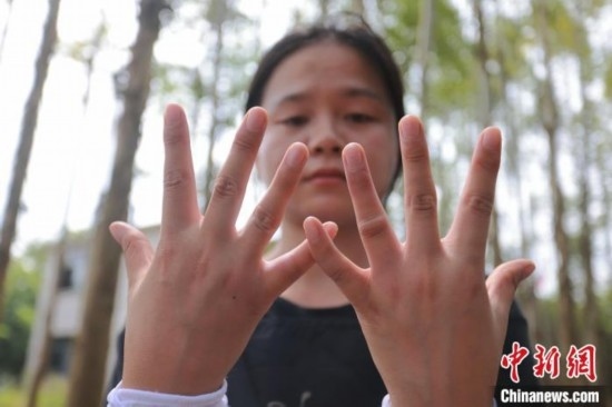 吳素英展示被蜜蜂蜇過的雙手。湯曉逵 攝