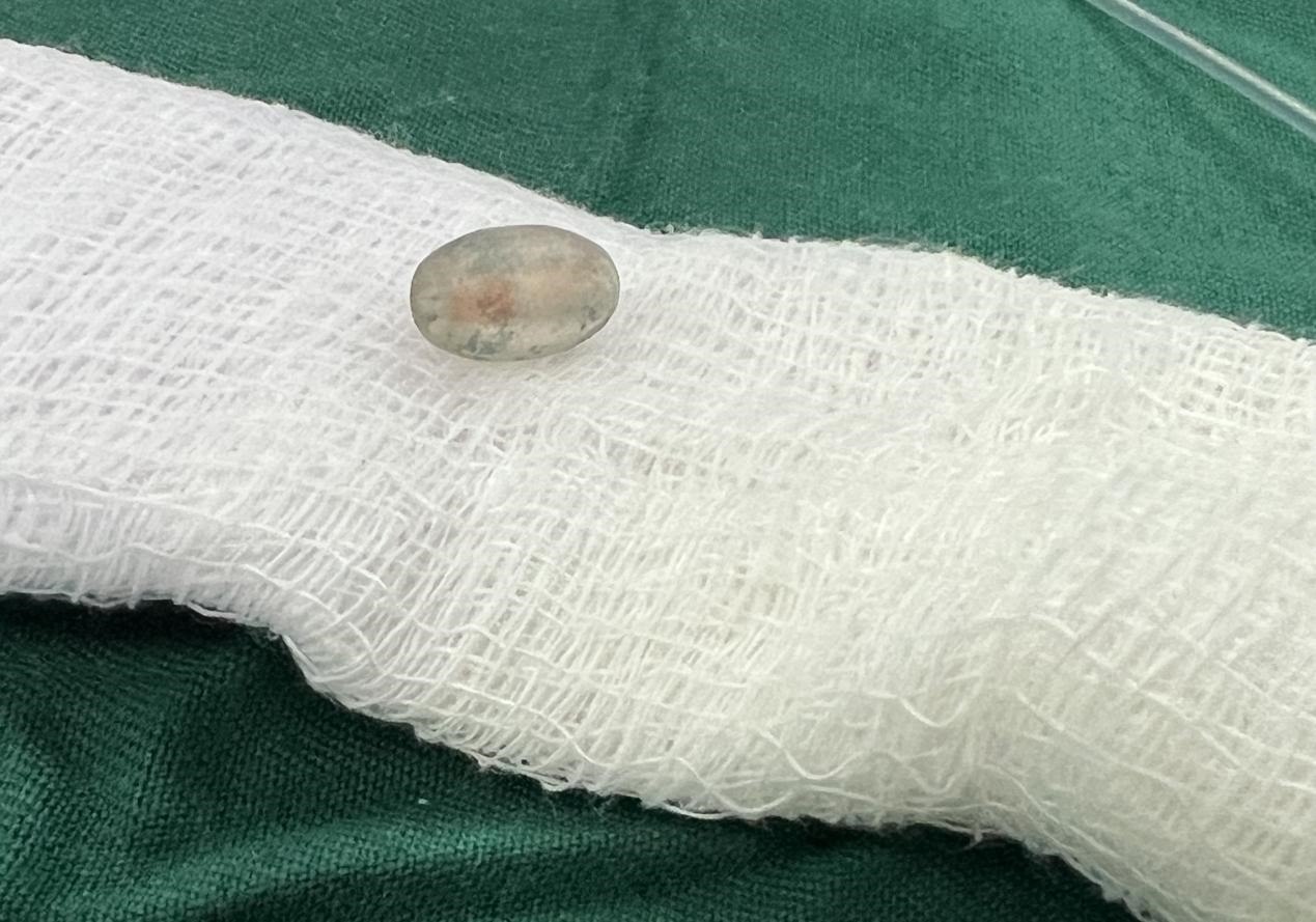 被取出的異物。中國(guó)援桑醫(yī)療隊(duì)供圖
