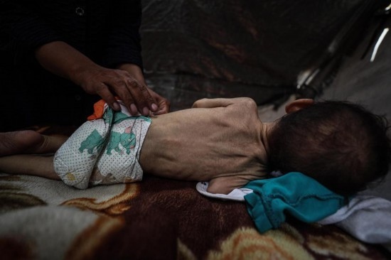 這是5月28日在加沙城西部一處臨時(shí)安置點(diǎn)拍攝的一名營(yíng)養(yǎng)不良的嬰兒。新華社發(fā)（馬哈茂德·扎基攝）